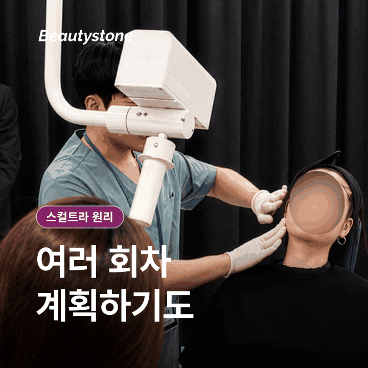 Sculptra for Nasolabial Folds: Does the Effect Appear Immediately Like Filler? Including How Long It Lasts image 4