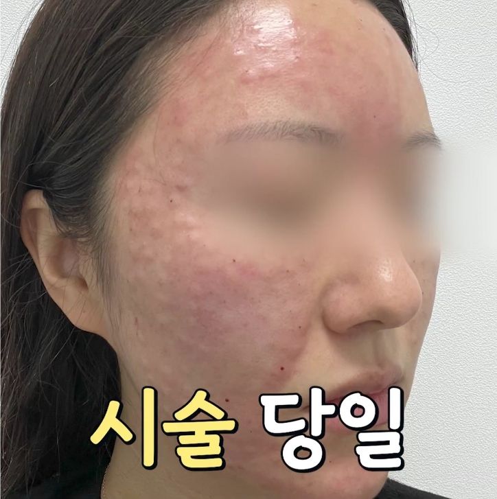 신촌 피부과 리쥬란 힐러 효과, 1주간의 변화 관련 이미지 2