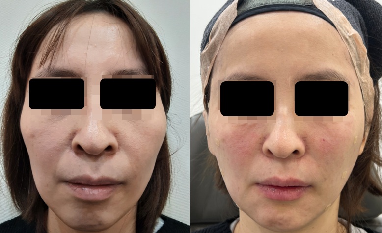 관자놀이 필러 시술 후 만족도가 달라지는 옆볼필러 조합 관련 이미지 2