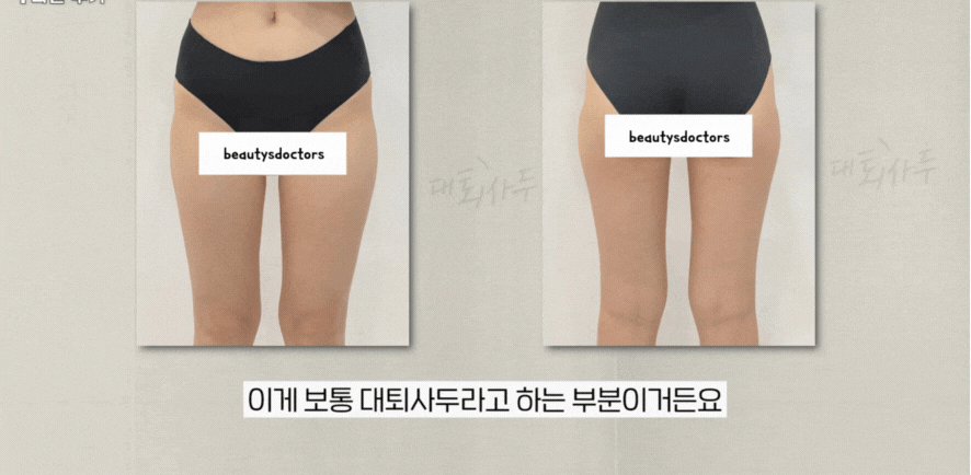 힙딥필러 효과는? 운동으로 어려운 힙딥 보정 방법 관련 이미지 2
