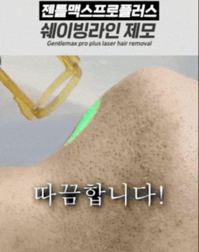 남자 레이저 제모, 두 가지만 확인하세요 관련 이미지 3