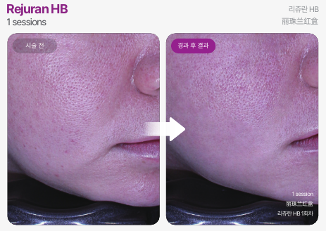 홍대 리쥬란HB 효과 언제까지 갈까? 지속기간과 관리 방법 정리 관련 이미지 2