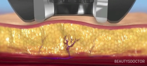 인모드 FX vs 포마 차이, 효과 없는 이유? 시술주기가 더 중요합니다 관련 이미지 2