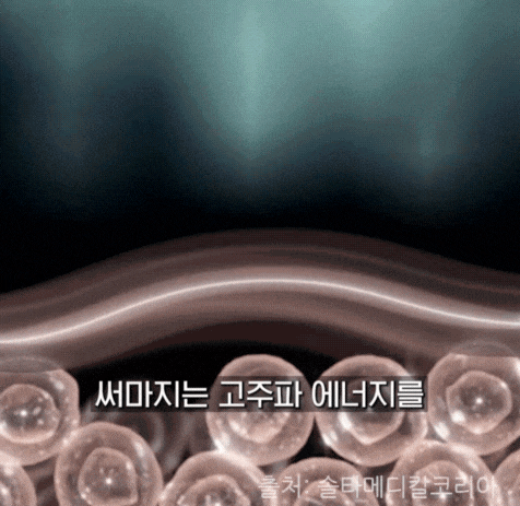 망원 피부과, 울쎄라 vs 써마지 차이 비교 관련 이미지 4