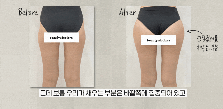 힙딥필러 효과는? 운동으로 어려운 힙딥 보정 방법 관련 이미지 3