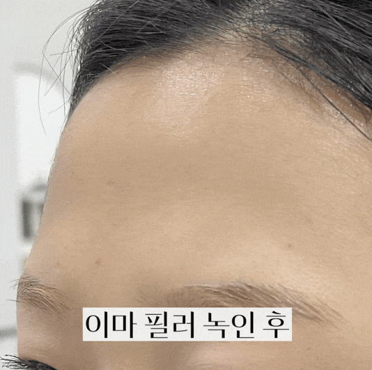 파주 피부과 이마필러 잘하는 곳, 후기를 통해 알아보 관련 이미지 4