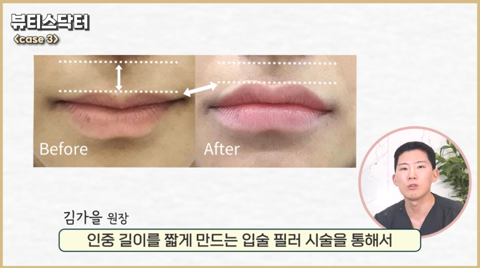 강서 피부과 입술필러와 입꼬리보톡스 같이 해야 할까요? 관련 이미지 2