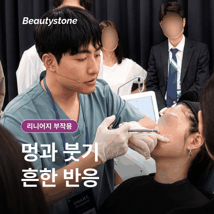 까치산역 인모드 부작용, FX 멍과 포마 열감은 어디까지 괜찮을까요? 관련 이미지 3