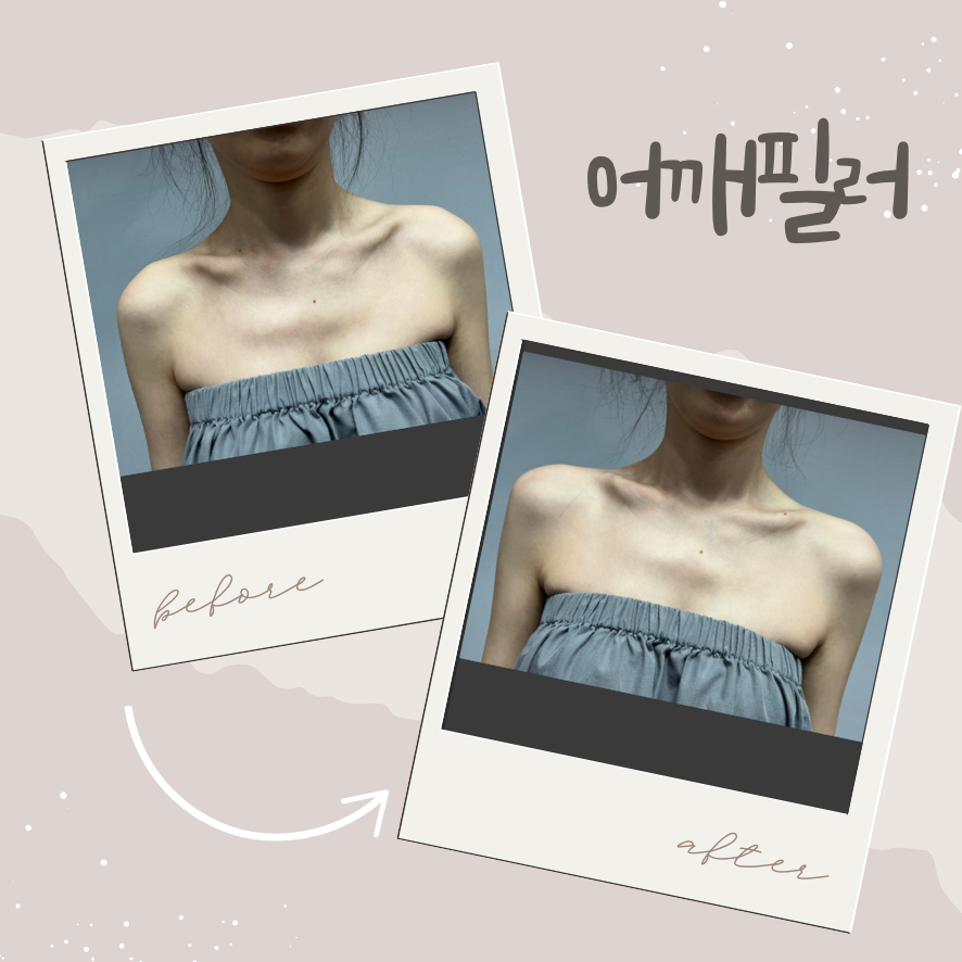 어깨필러와 승모근 보톡스의 황금 밸런스, 직각 어깨의 완성 관련 이미지 1