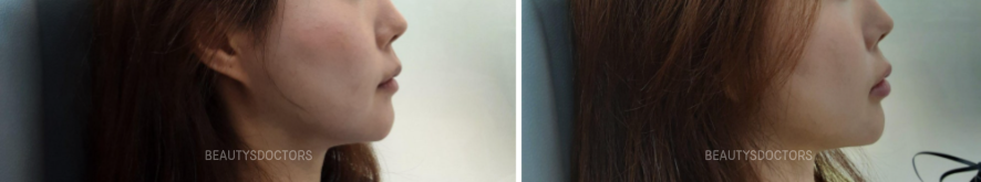 입술필러 통증 고통 어느정도일까? 1cc로 보는 후기 관련 이미지 4