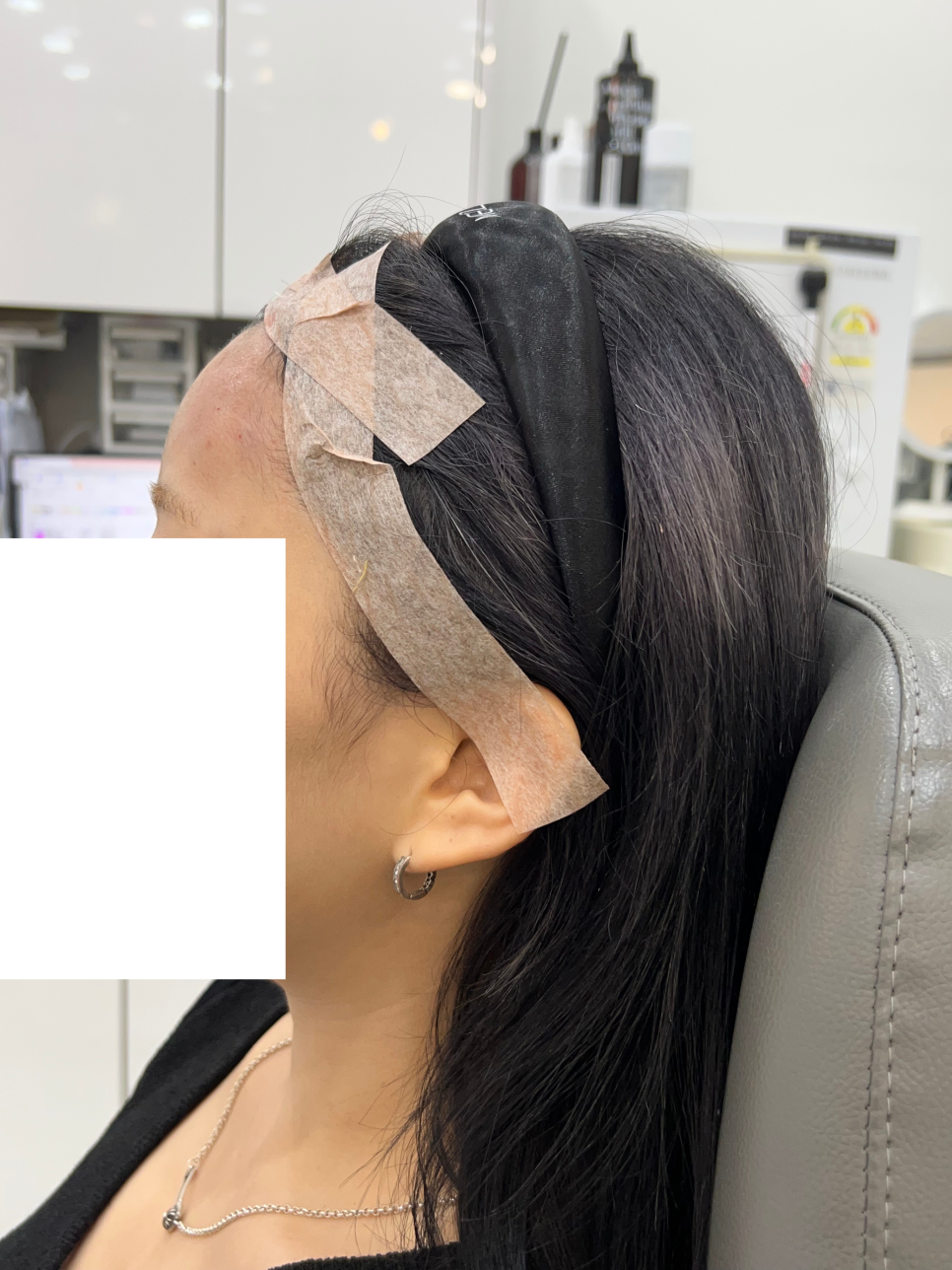 홍대 이마 필러 잘하는 곳, 두가지만 확인하세요 관련 이미지 2