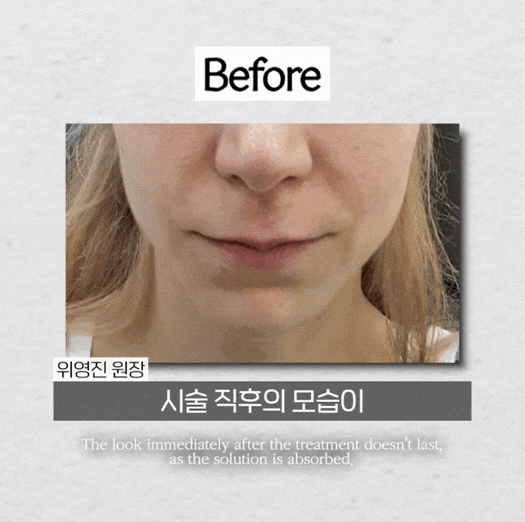 연신내 피부과 스컬트라 Q&A 효과&middot;유지기간&middot;부작용까지 정리 관련 이미지 3