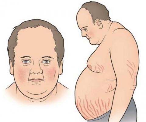 가수 이은하 쿠싱증후군, 급격한 20kg증량 쿠싱증후군 증상과 예방법 관련 이미지 1