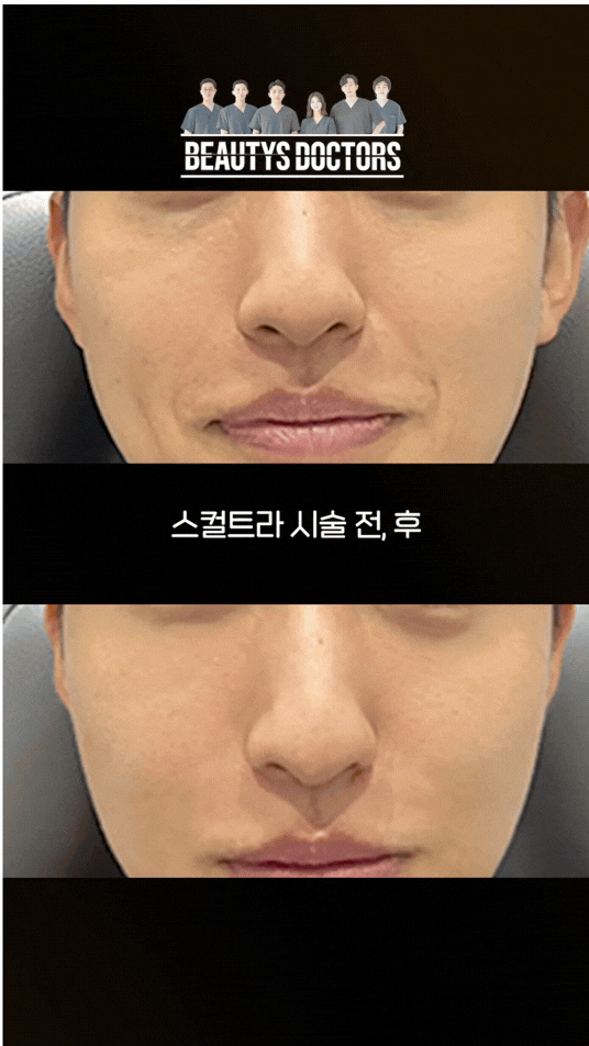 스컬트라 효과 나타나는 시기 뭉침 없이 받는 방법까지 정리했습니다 관련 이미지 3