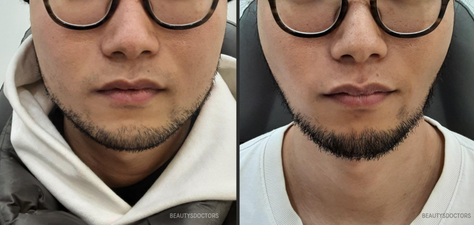 사각턱 보톡스 전후 변화, 효과 언제부터 보일까? 관련 이미지 3