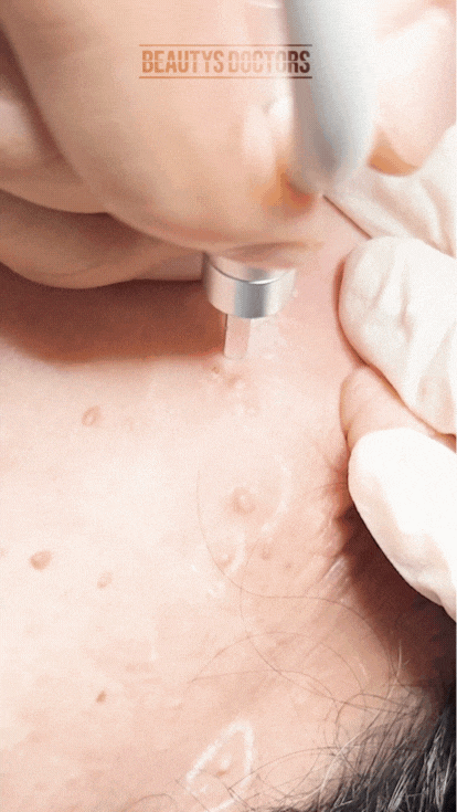 비립종 피부과에서 해결하는 법 관련 이미지 3