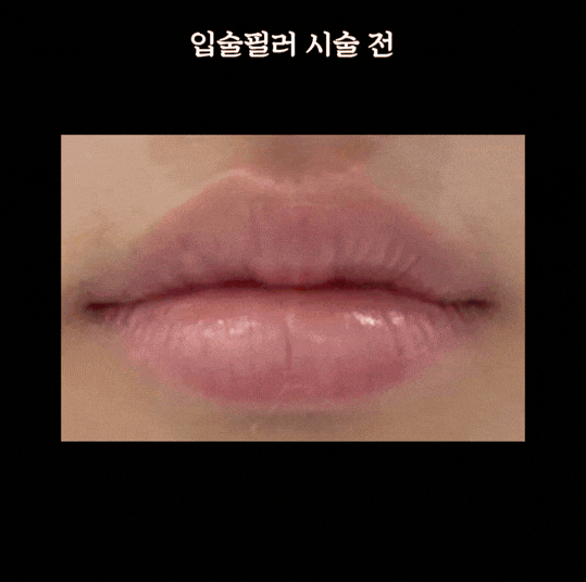 공덕동 피부과 입술필러 전후 후기와 통증까지, QnA로 정리했습니다 관련 이미지 2