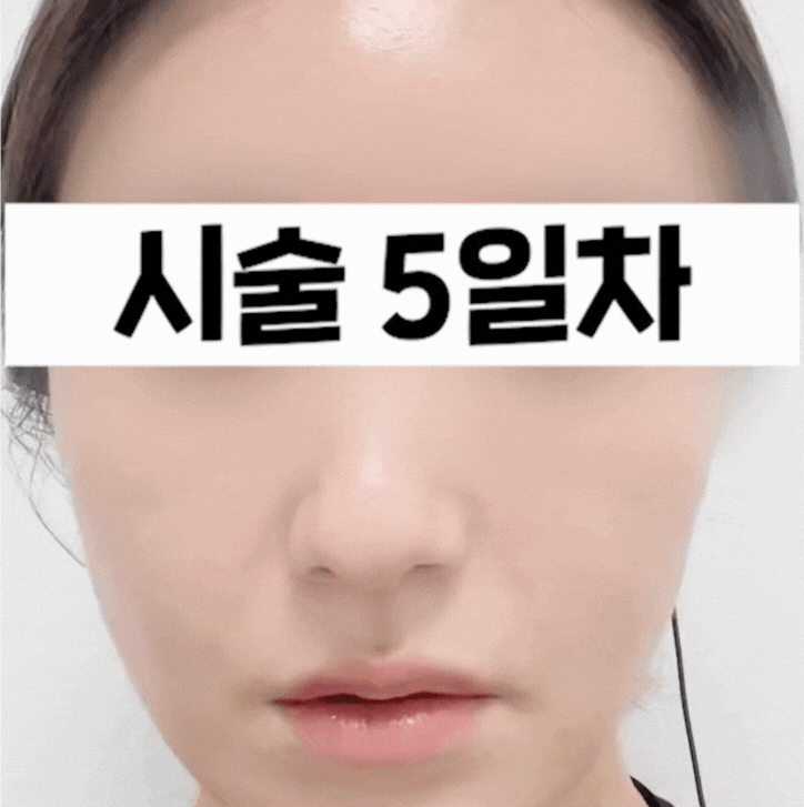 신촌 피부과 리쥬란 힐러 효과, 1주간의 변화 관련 이미지 4