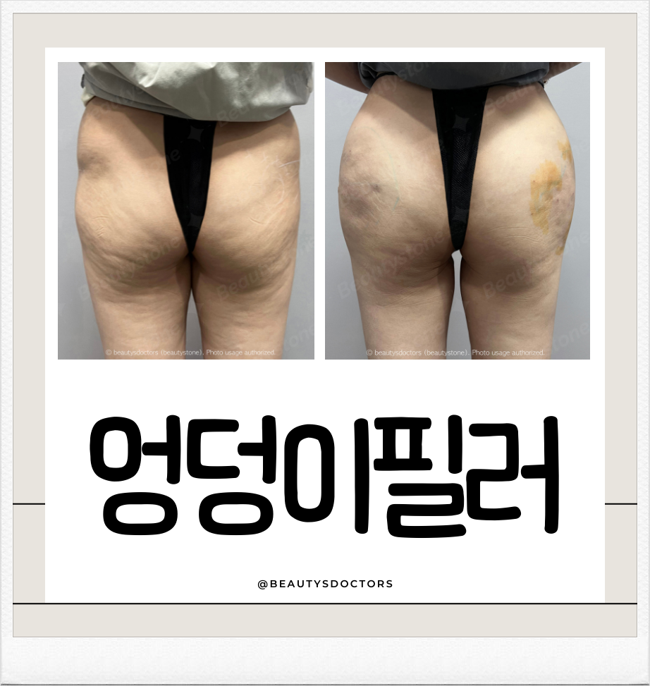Mapo Dermatology Hip Dip Filler: How to Naturally Enhance the Line image 5