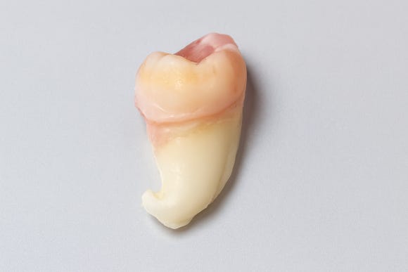 사랑니 뿌리 휘어짐, 발치가 가능할까요? 관련 이미지 1