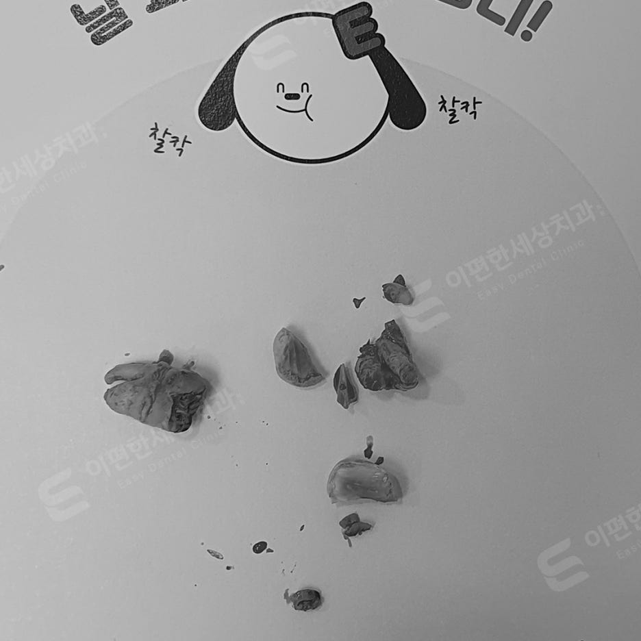 사랑니 발치 치과, 찾는 분들 읽어보세요. 관련 이미지 17