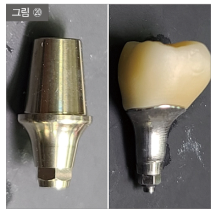 등촌역치과 임플란트 비용 사람마다 다 다른 이유 관련 이미지 4