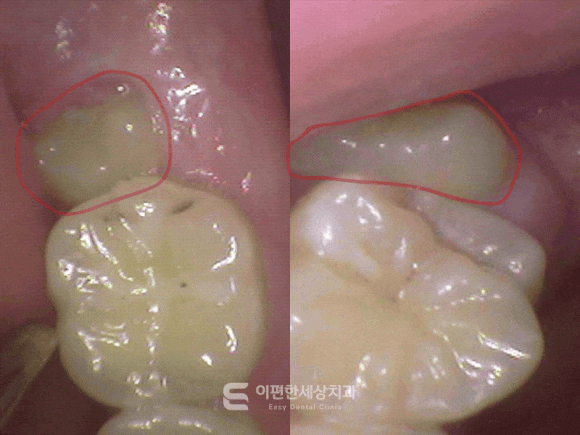 강서매복사랑니 한 번에 4개 발치 가능할까? 관련 이미지 3
