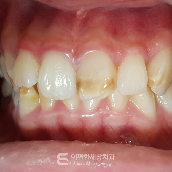 개화산역교정치과 과개교합과 윗니 돌출의 차이점은 무엇일까요? 관련 이미지 4