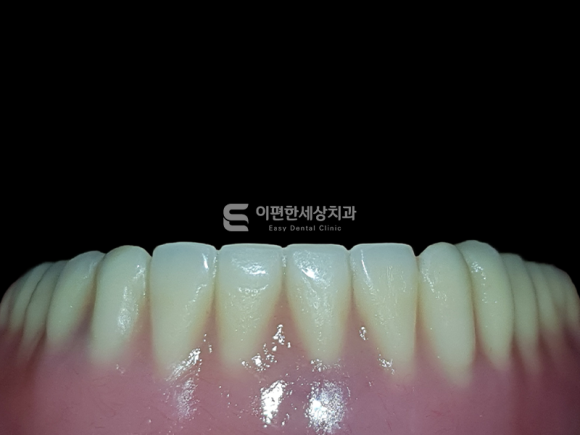 화곡동임플란트 틀니(오버덴쳐) 어떤 상황에서 필요할까요? 관련 이미지 5