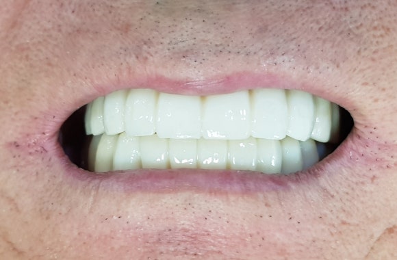 서울강서구임플란트, 고령 환자라면 꼭 확인해야 할 내용 관련 이미지 3