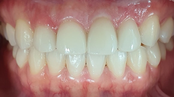 강서구라미네이트 실패하기 싫다면 꼭 읽어봐야 할 글 관련 이미지 4