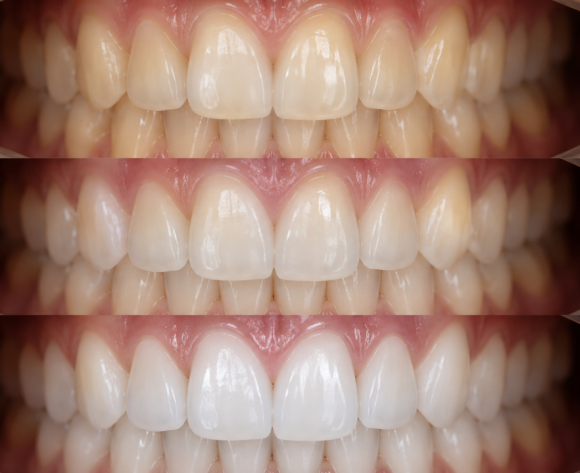 Seoul One-Day Teeth Whitening: How Many Sessions Does It Take to Brighten Your Smile? image 6