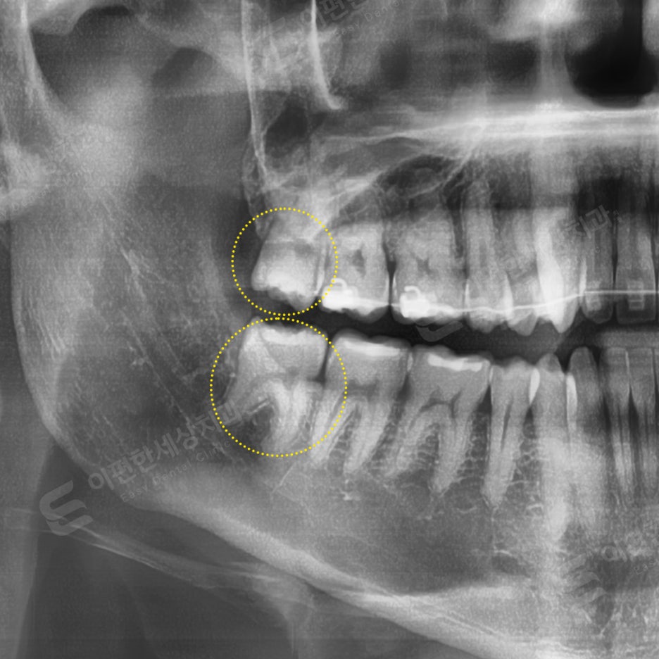 사랑니 발치 치과, 찾는 분들 읽어보세요. 관련 이미지 13