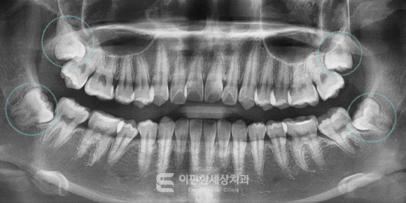 원종역교정치과 교정치료를 위해 사랑니 발치가 필요한 이유는? 관련 이미지 2