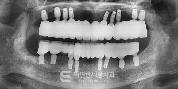Seoul Implant: Worried About Wisdom Tooth Extractions? (ft. Conscious Sedation) image 5