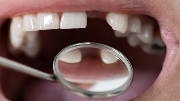 화곡역임플란트치과 선택이 고민이시라면 읽어보세요 관련 이미지 1