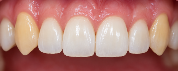 Can Yellowish Canines Be Improved with Teeth Whitening? image 3