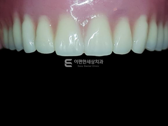 화곡동임플란트 틀니(오버덴쳐) 어떤 상황에서 필요할까요? 관련 이미지 6