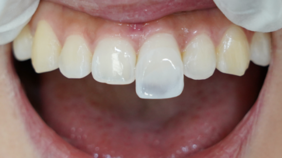 강서구라미네이트 실패하기 싫다면 꼭 읽어봐야 할 글 관련 이미지 1