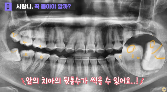 강서구치과, 사랑니 발치 꼭 해야 할까? 미루면 안 되는 경우 관련 이미지 6