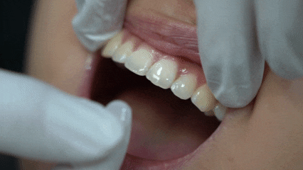 서울화곡동치과 라미네이트 이 기준으로 해야 후회 없습니다 관련 이미지 5