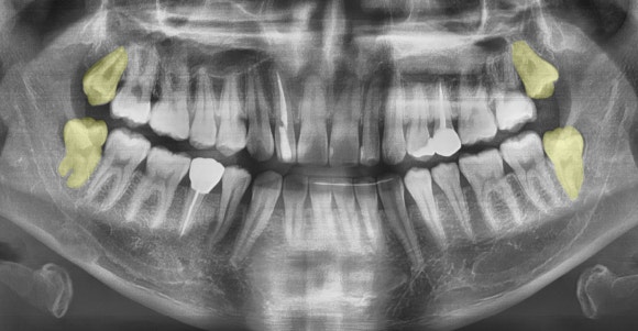 Gangseo-gu wisdom tooth extraction: why is it different for each person? image 3