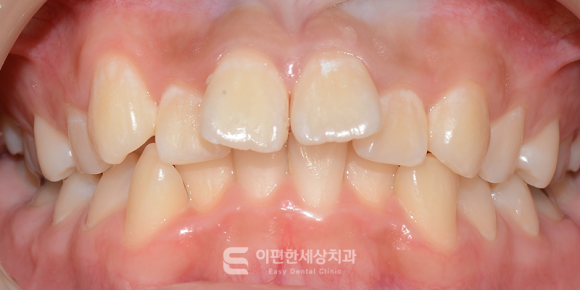 화곡동교정치과 심한 앞니 돌출, 교정이 필요한 이유는? 관련 이미지 3