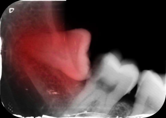 강서구사랑니발치 꼭 해야 할 지 고민이라면 5분만 투자해서 읽어보세요 관련 이미지 4