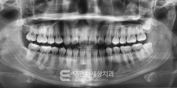 사랑니 엑스레이 CT, 촬영하는 이유는?(강서구화곡동사랑니) 관련 이미지 3