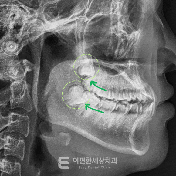 원종역교정치과 교정치료를 위해 사랑니 발치가 필요한 이유는? 관련 이미지 1