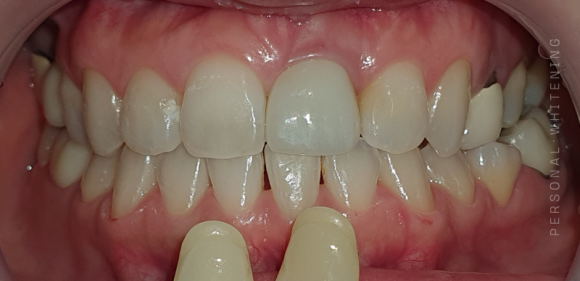 Seoul One-Day Teeth Whitening: How Many Sessions Does It Take to Brighten Your Smile? image 5