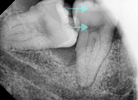 화곡역사랑니 신경 손상 가능성 있어도 대학병원 안 가도 되는 진짜 이유 관련 이미지 5
