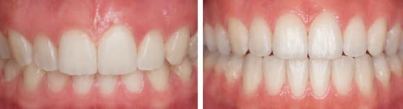 Hwagok Bon-dong Teeth Alignment: My Upper Teeth Cover My Lower Teeth! Can Orthodontic Treatment Improve an Overbite? image 1