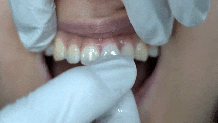 강서구 라미네이트 치과, 시술 전 후회하지 않으려면 꼭 확인하세요 관련 이미지 3